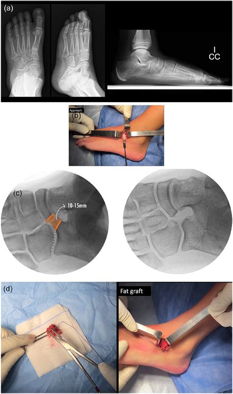 Tarsal Coalition: Surgical Management in the Young Athlete - Javier