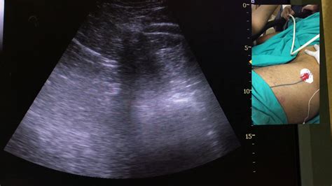 Ultrason Eşliğinde Lomber Pleksus Bloğu Ultrasound Guided Lumbar