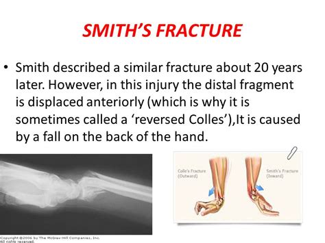 Colles Vs Smith Fracture - cloudshareinfo