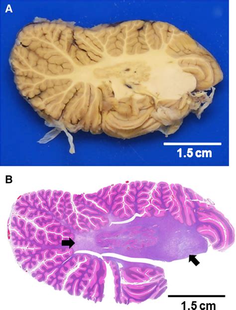 Gross Findings Of A Sagittal Slice A Of The Left Cerebellar