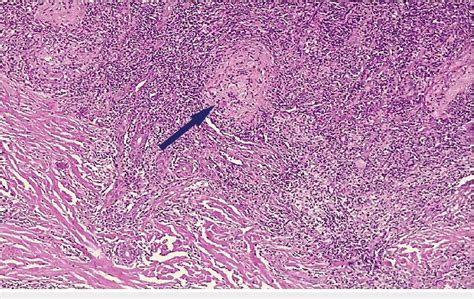 Histology Section Showing Dense Chronic Inflammatory Infiltrate Giant