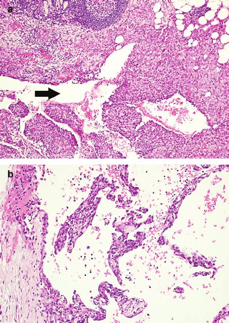 (a) Histology shows lymph node (top) abutted by metastatic... | Download Scientific Diagram