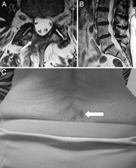 Synovial Cyst Lumbar Spine Surgery