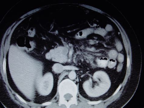 Mesenteric Venous Thrombosis Surgery Photos