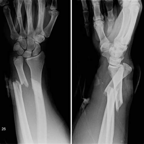 Plain Posteroanterior And Profile Radiographs Of The Left Wrist And