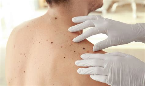 Skin Cancer Clinic In Melbourne Book Now Mole Check Clinic