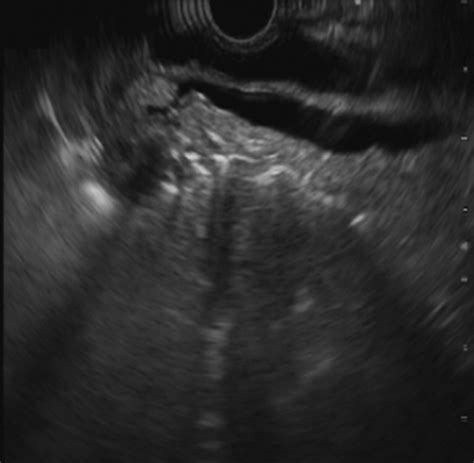 Endoscopic Resection Of An Unusual Ampullary Adenoma Videogie