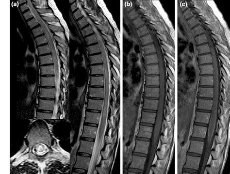 Mri Of The Thoracic Spine A T Weighted Images Sagittal And