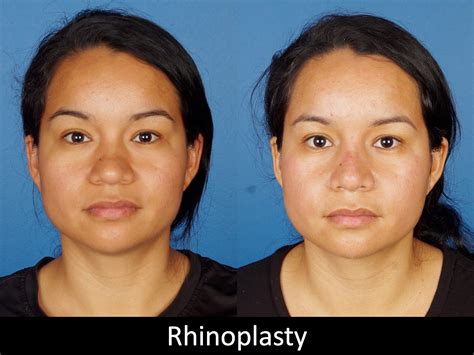 Denver Rhinoplasty Before And Afters Raval Facial Aesthetics