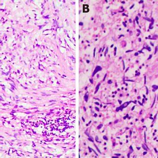 Histopathological Findings Of Inflammatory Myofibroblastic Tumor A