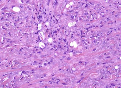 Primary Cutaneous Epithelioid Hemangioendothelioma With Lymph Node