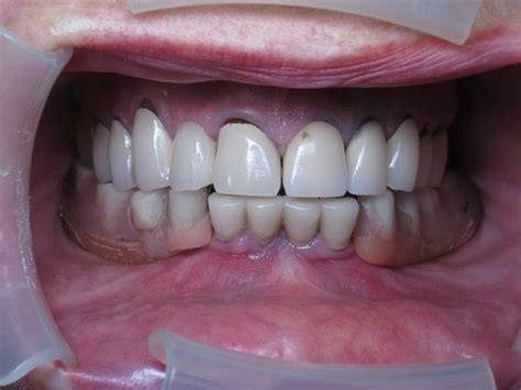 Case 6 - Prettau Zirconia Implant Bridge - Before and After Gallery