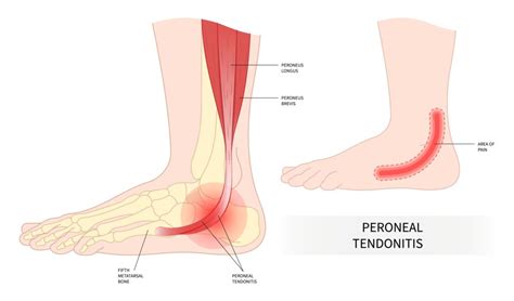 Peroneus Brevis Tendon Injury - ProHealth Prolotherapy Clinic