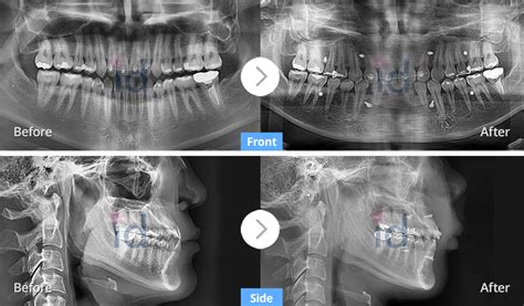 Orthognathic Surgery X Ray