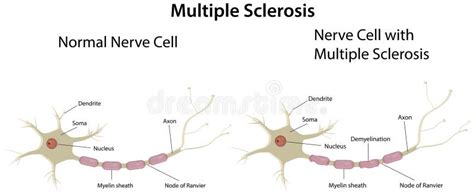 Multiple Sclerosis Diagram Stock Vector Image 39896855