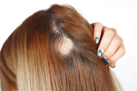 Laser Cap Treatment for Hereditary Hair Loss: Does It Really Work?: Honest Hair Restoration ...