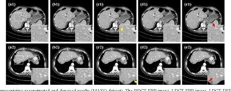 Figure 1 From Denoising Low Dose Ct Images Using A Multi Layer