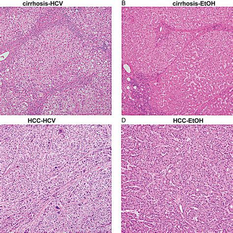 Hepatocellular Carcinoma Histology