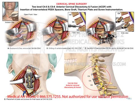 2 Level C4 5 And C5 6 Anterior Cervical Discectomy And Fusion Acdf