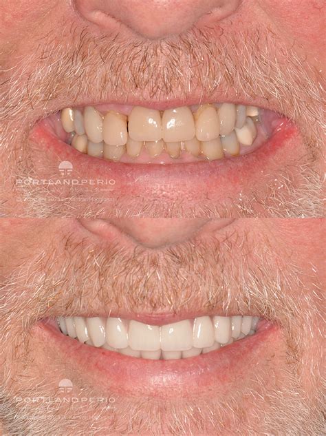 All On Dental Implant Case Study Eric Portland Perio Implant Center