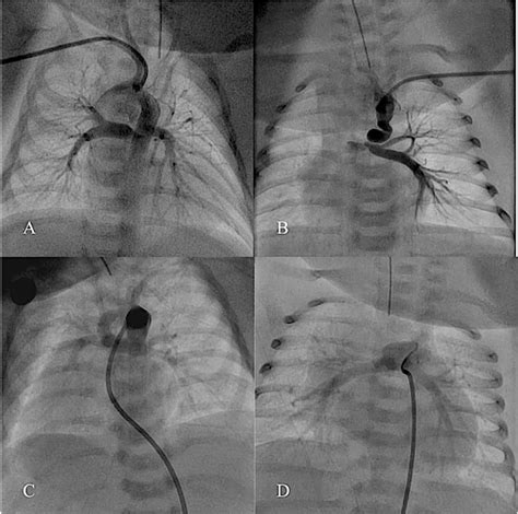 Figure 2 From Technical Modifications For Ductal Stenting In Neonates