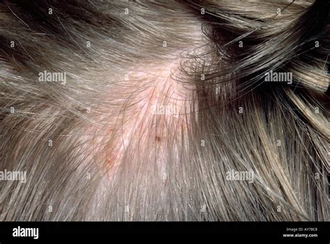 Tinea Capitis Immagini E Fotos Stock Alamy