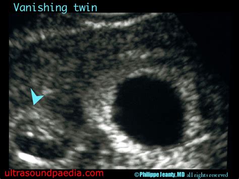 Vanishing Twin Ultrasoundpaedia