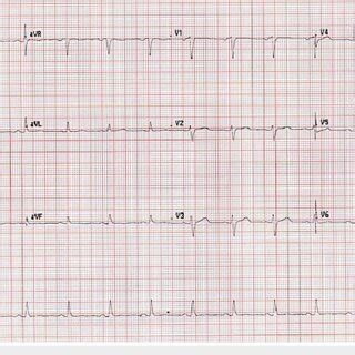 Electrocardiography Ecg Showed A Regular Sinus Rhythm With An