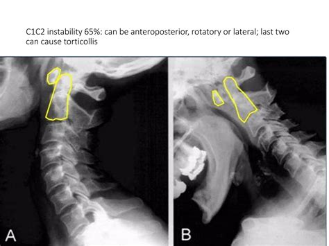 Lecture occipital cervical fusion for rheumatoid arthritis | PPTX
