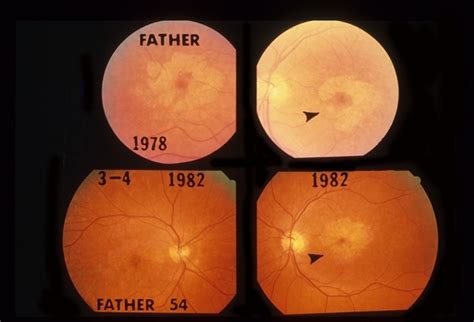 Pattern Dystrophy - Retina Image Bank