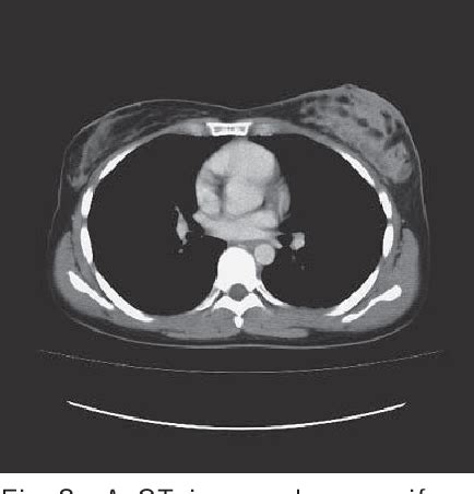 Figure From A Case Of Granulomatous Lobular Mastitis Successfully