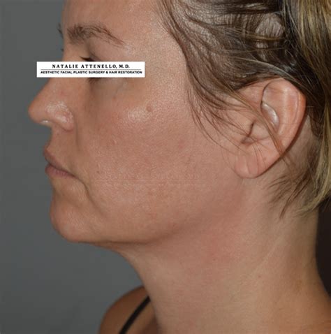 Beverly Hills Facelift Before And After Photos Los Angeles Plastic