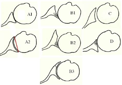 Management Of The B2 Glenoid In Glenohumeral Osteoarthritis Orthopedic Clinics