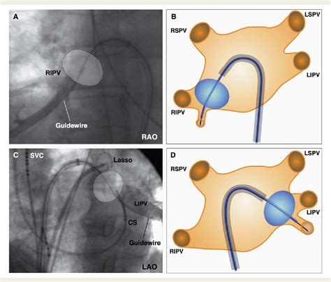 Figure 2 From The ‘single Big Cryoballoon Technique For Acute Pulmonary Vein Isolation In