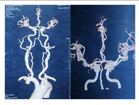 Figure 1 From Endovascular Treatment Of Unruptured Intracranial