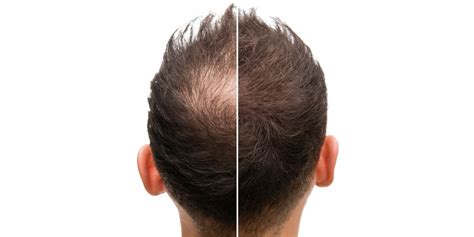 Tipuri De Alopecie I Tratament Dr Leventer Centre