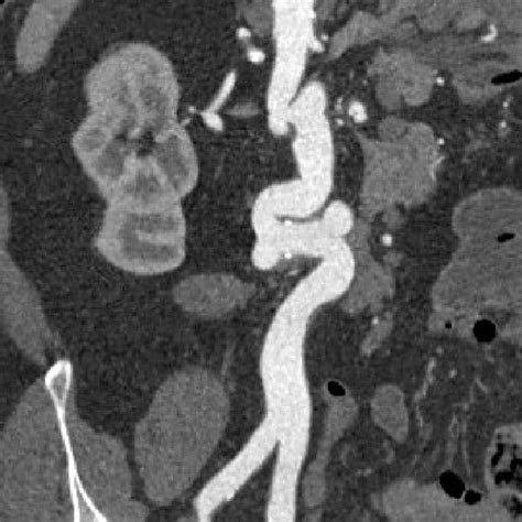 3d Recostruction Of The Abdominal Aorta Demonstrates The Presence Of At Download Scientific