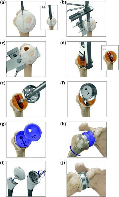 Arthrex Univers Revers Shoulder Prosthesis Musculoskeletal Key