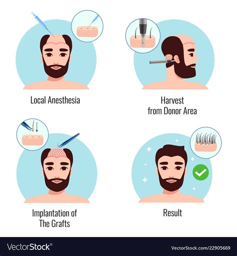 Hair Transplantation Design Concept Royalty Free Vector