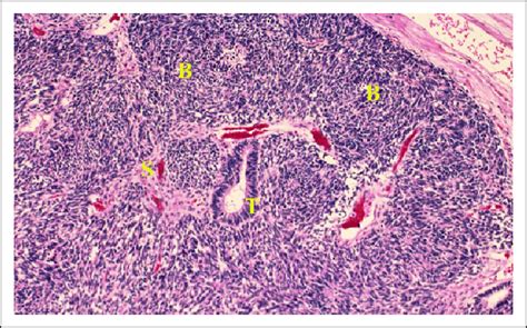 Blastema Predominant Wilms Tumor Composed Of Small Round Blue Cells B