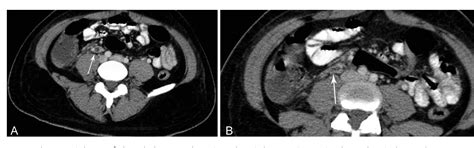 Figure 2 From Septic Pelvic Thrombophlebitis Of Unknown Origin An Ever Threatening Entity