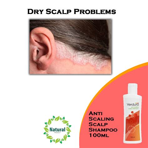 Natural Treatments For Dry Scalp