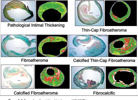 Figure 1 From Virtual Histology Intravascular Ultrasound Assessment Of