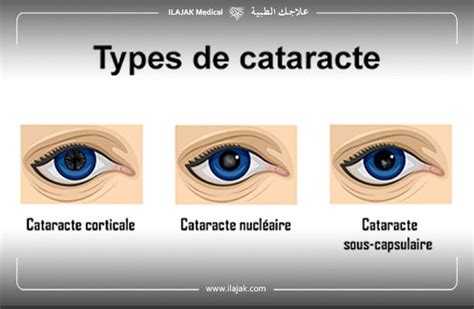 Tout savoir sur la cataracte Ilajak médical