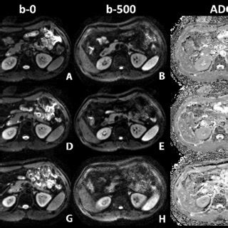 Representative Transverse DWI Images And Corresponding ADC Maps At The