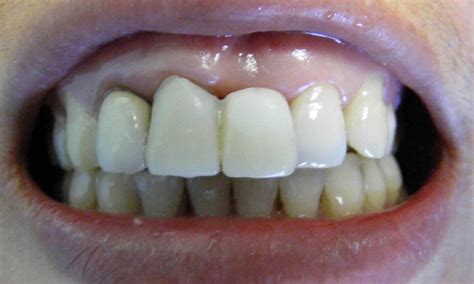 Dental Implant For Front Tooth And Crown For Front Tooth Before And After Photos Brookings Sd