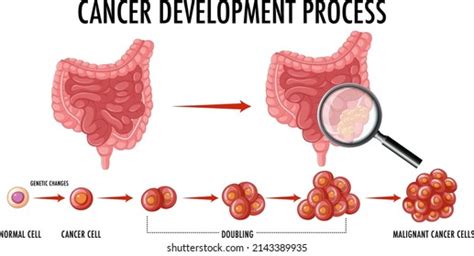 Diagram Showing Cancer Development Process Illustration Stock Vector