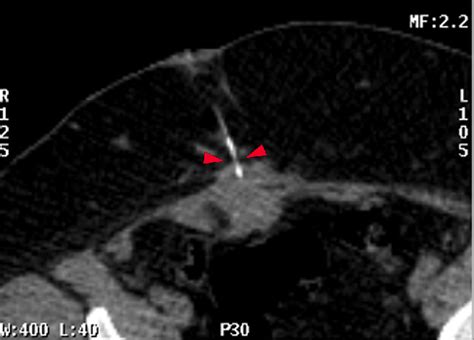 Figure 1 From Use Of Wire Guided Localization For Resection Of