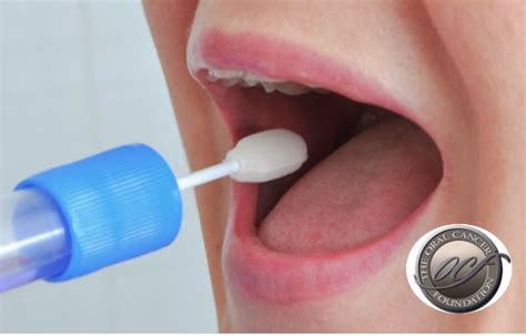 Novo teste de saliva para diagnóstico do cancro oral e da garganta