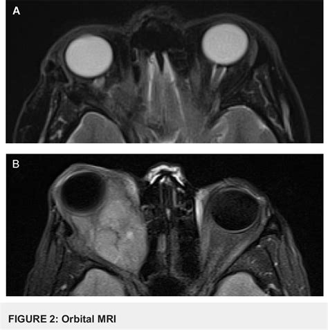 Figure 2 From An Orbital Malignant Melanoma Arising In Cellular Blue